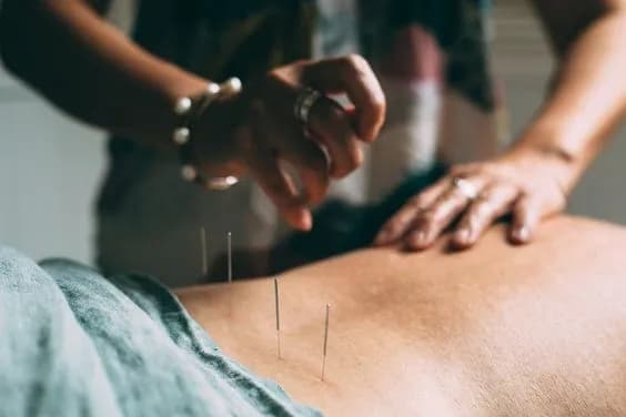 Sesión de Acupuntura en Medicina Tradicional China